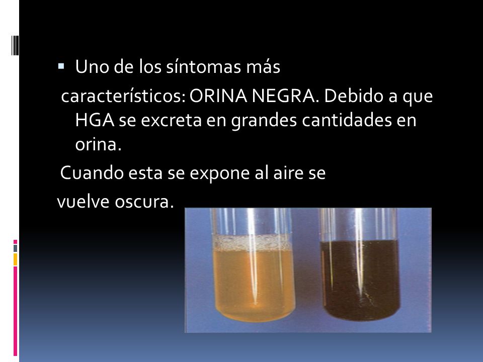 Uno de los síntomas más característicos: ORINA NEGRA. Debido a que HGA se excreta en grandes cantidades en orina.