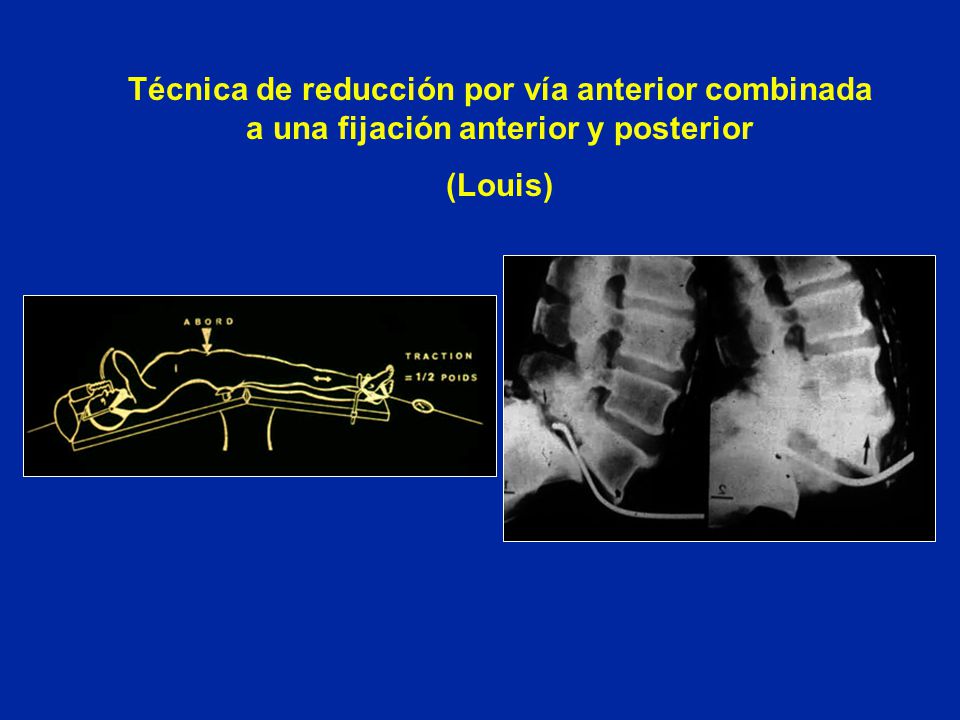 Técnica de reducción por vía anterior combinada a una fijación anterior y posterior