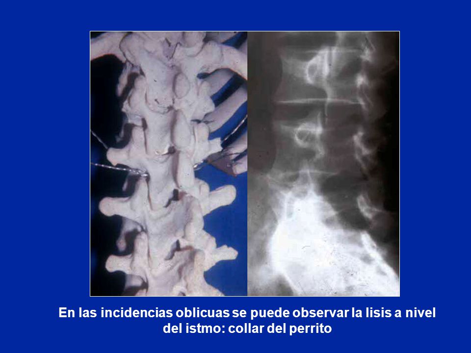 En las incidencias oblicuas se puede observar la lisis a nivel del istmo: collar del perrito