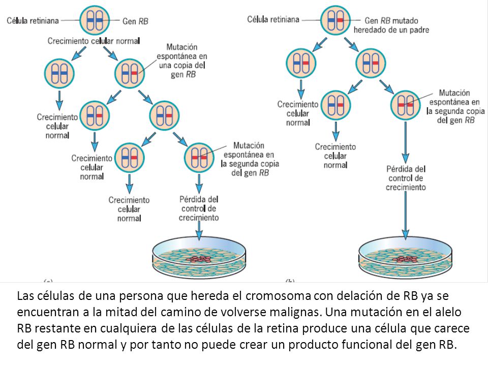 Las células de una persona que hereda el cromosoma con delación de RB ya se encuentran a la mitad del camino de volverse malignas.