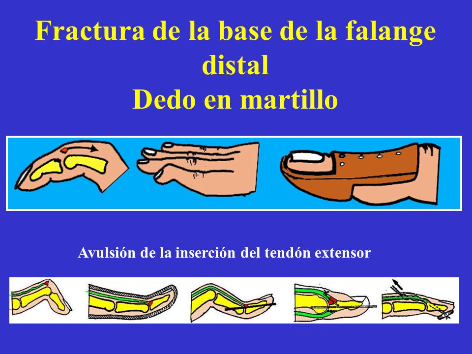 Fractura de la base de la falange distal Dedo en martillo