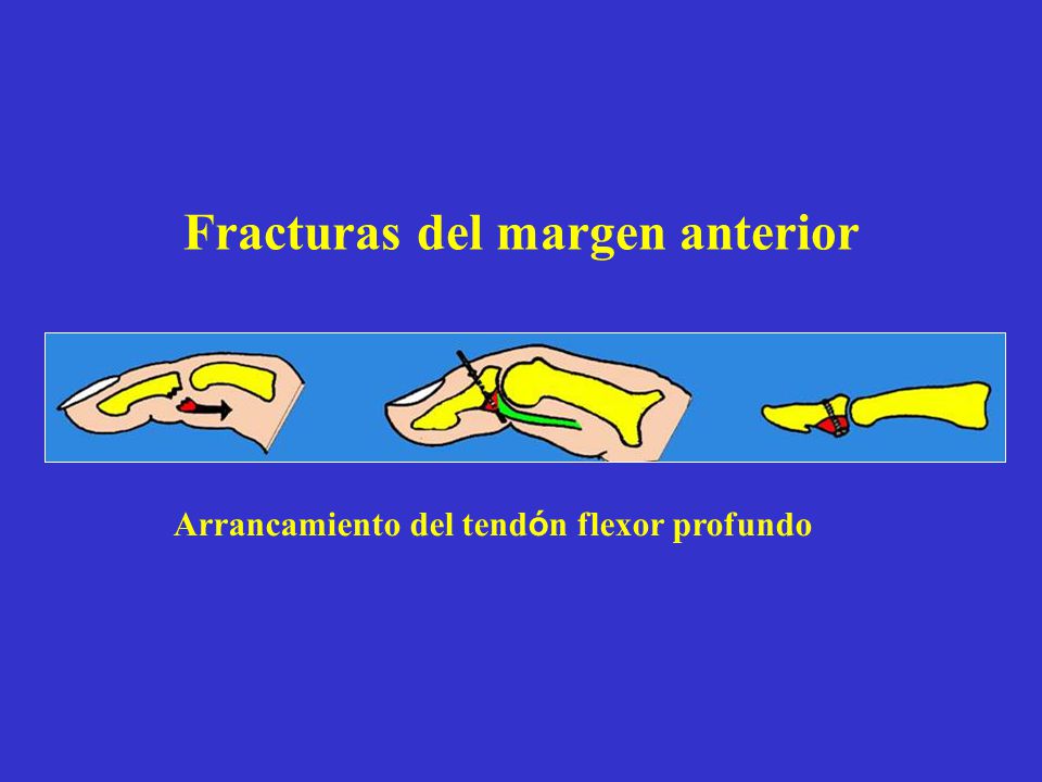 Fracturas del margen anterior Arrancamiento del tendón flexor profundo