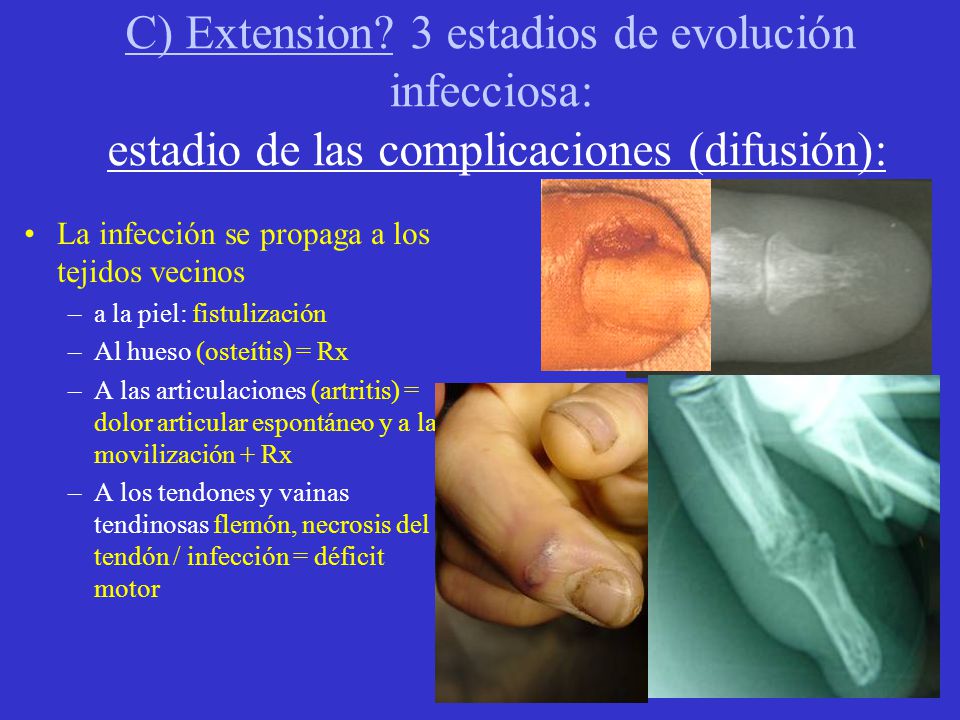 C) Extension 3 estadios de evolución infecciosa: estadio de las complicaciones (difusión):