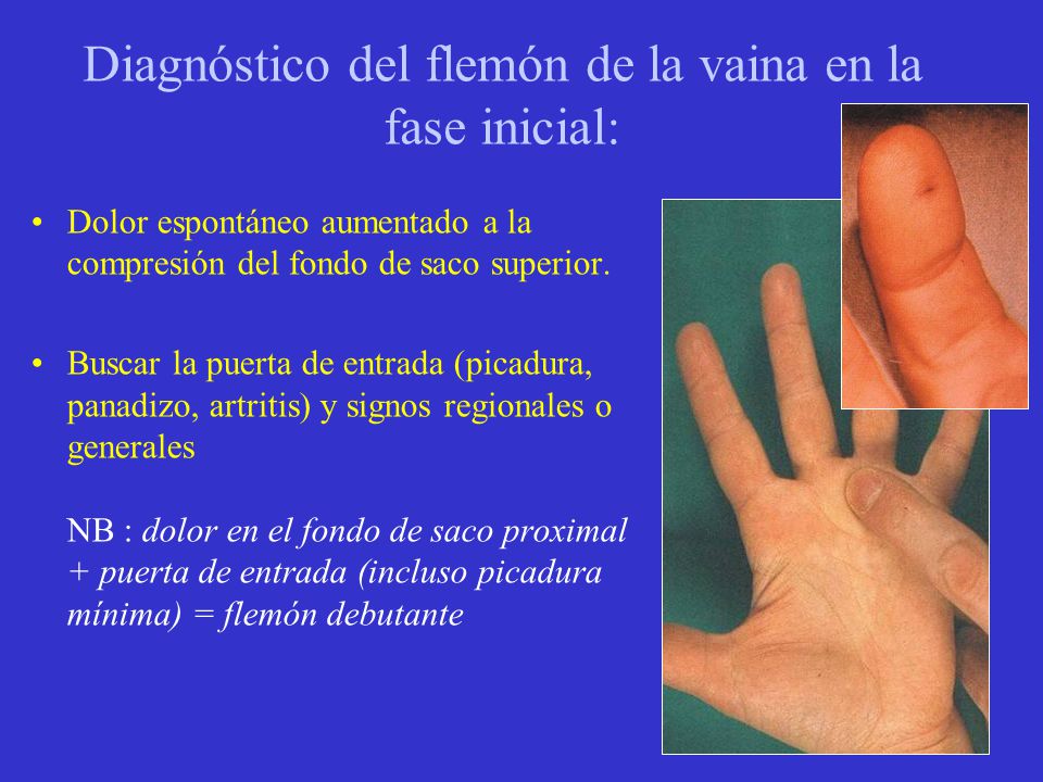 Diagnóstico del flemón de la vaina en la fase inicial: