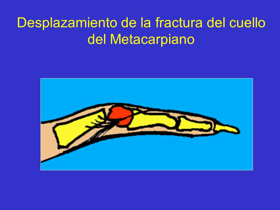 Desplazamiento de la fractura del cuello del Metacarpiano