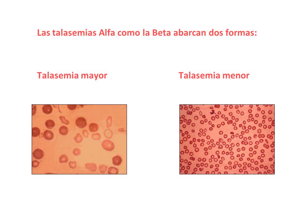 Las talasemias Alfa como la Beta abarcan dos formas: