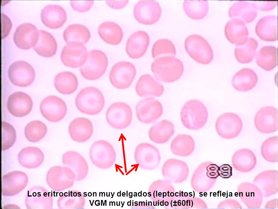 Los eritrocitos son muy delgados (leptocitos) se refleja en un VGM muy disminuído (±60fl)