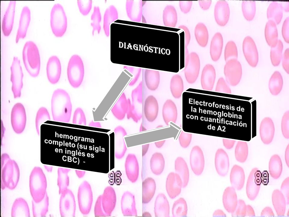 DIAGNÓSTICO hemograma completo (su sigla en inglés es CBC) -