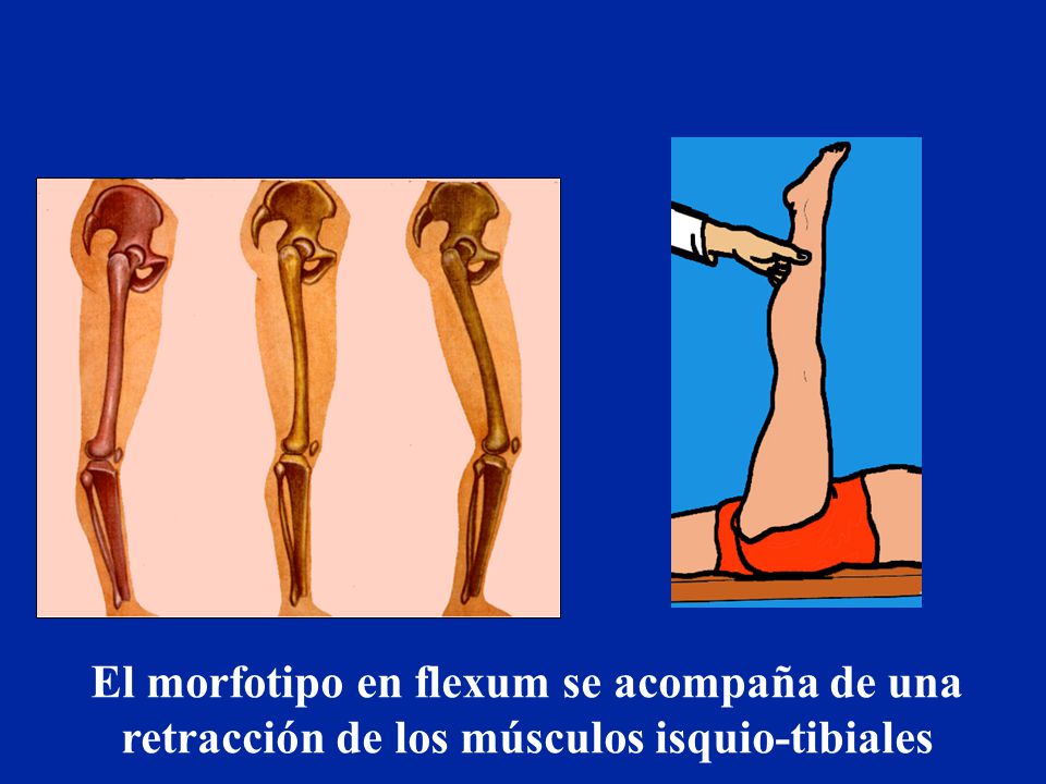 El morfotipo en flexum se acompaña de una retracción de los músculos isquio-tibiales