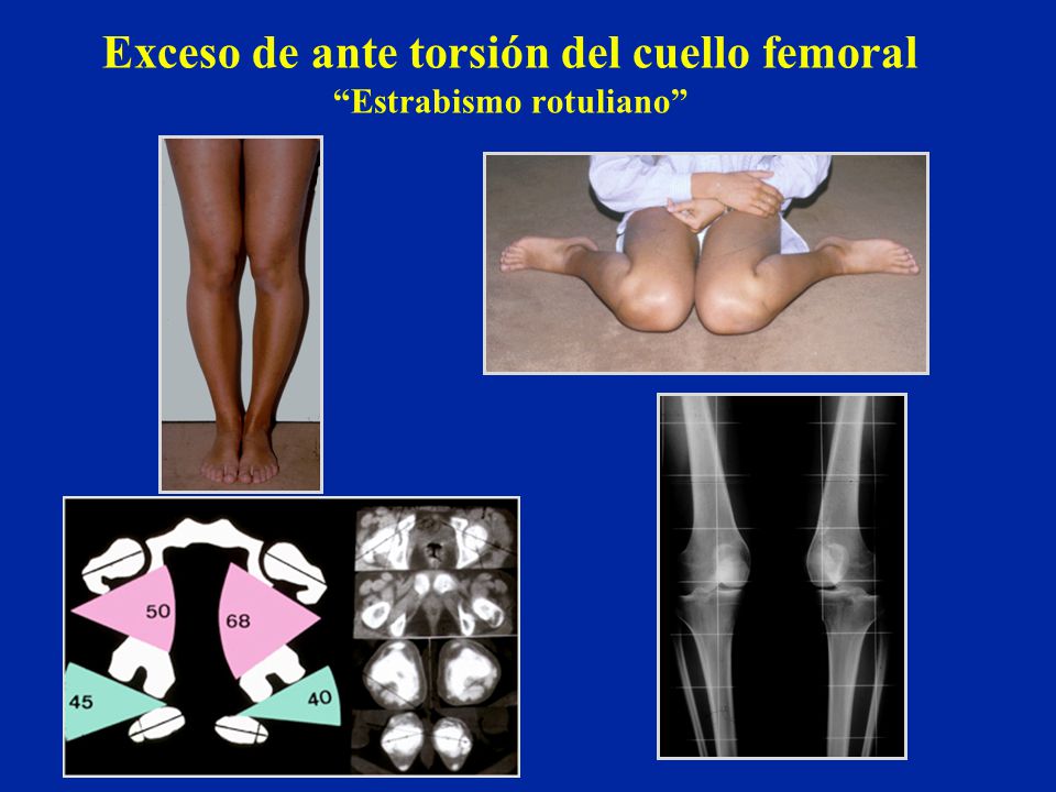 Exceso de ante torsión del cuello femoral Estrabismo rotuliano