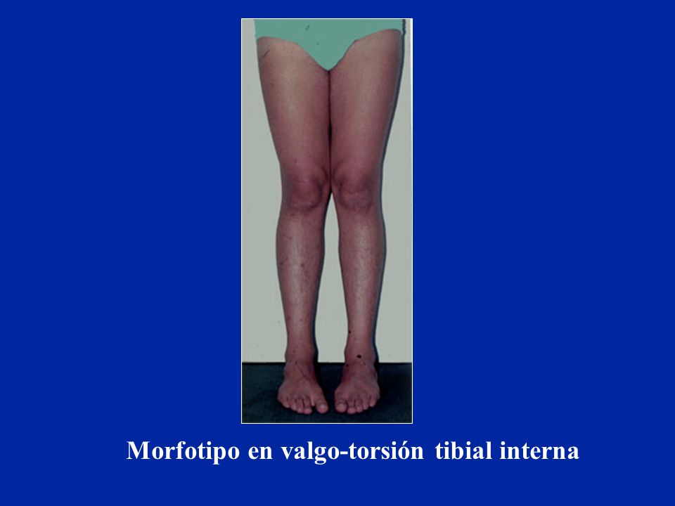 Morfotipo en valgo-torsión tibial interna