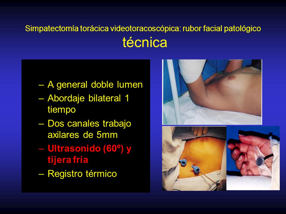 Abordaje bilateral 1 tiempo Dos canales trabajo axilares de 5mm