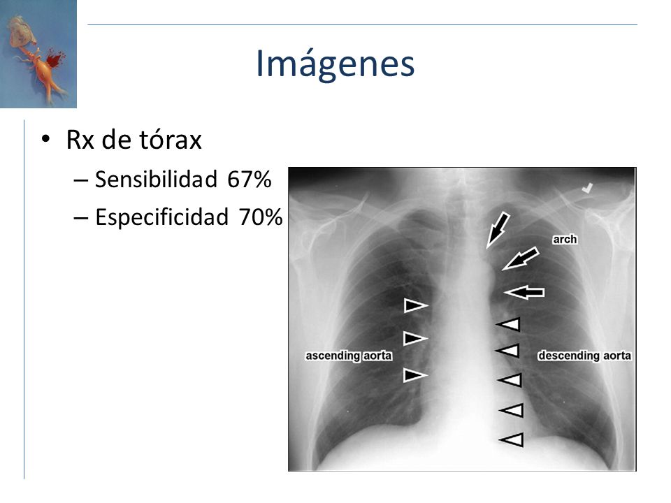 Imágenes Rx de tórax Sensibilidad 67% Especificidad 70%
