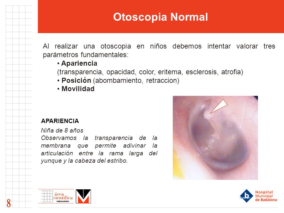 Otoscopia Normal Al realizar una otoscopia en niños debemos intentar valorar tres parámetros fundamentales: