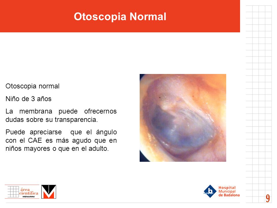 Otoscopia Normal 9 Otoscopia normal Niño de 3 años