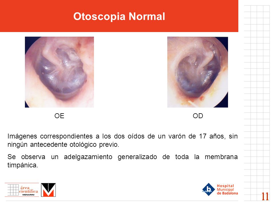 Otoscopia Normal OE. OD. Imágenes correspondientes a los dos oídos de un varón de 17 años, sin ningún antecedente otológico previo.
