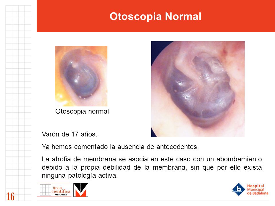 Otoscopia Normal 16 Otoscopia normal Varón de 17 años.