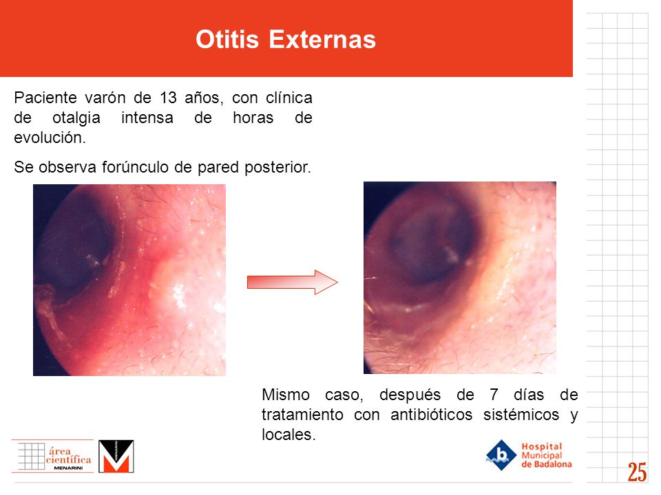 Otitis Externas Paciente varón de 13 años, con clínica de otalgia intensa de horas de evolución. Se observa forúnculo de pared posterior.