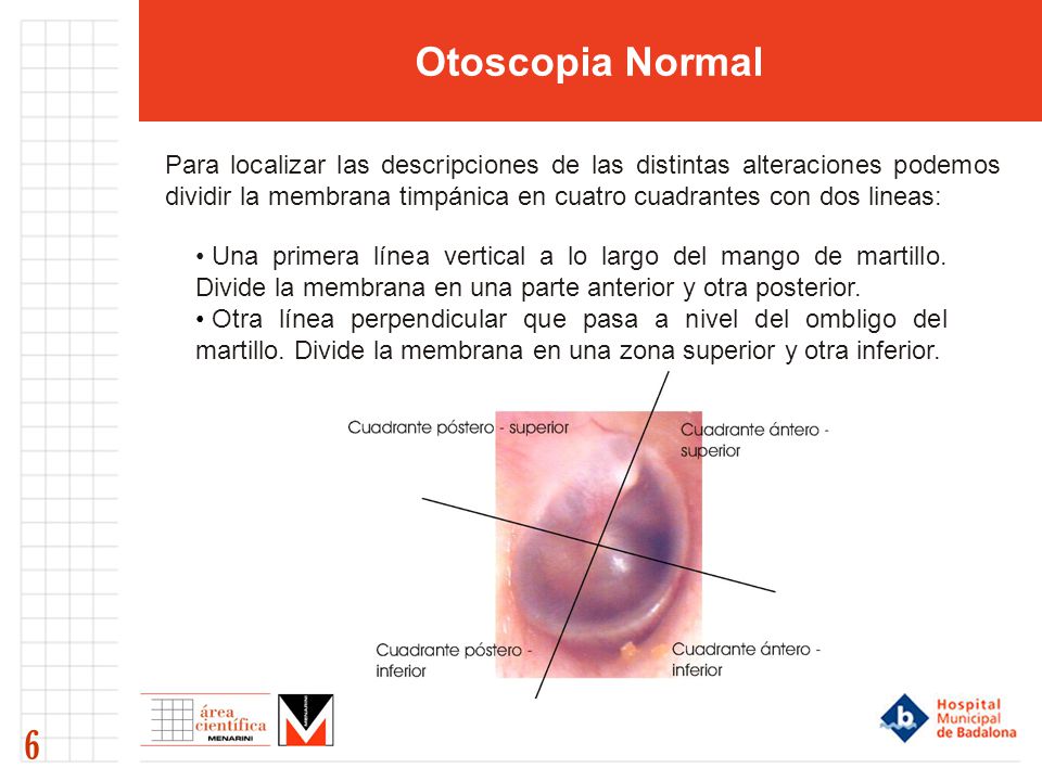 Otoscopia Normal