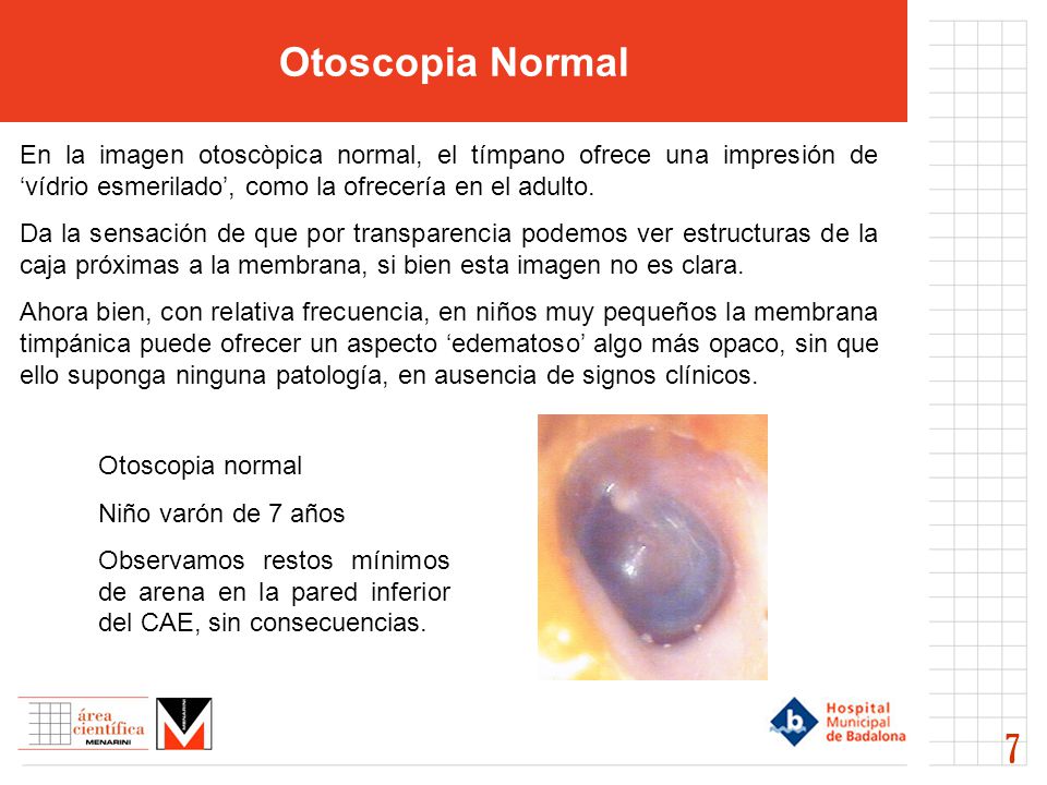 Otoscopia Normal En la imagen otoscòpica normal, el tímpano ofrece una impresión de ‘vídrio esmerilado’, como la ofrecería en el adulto.