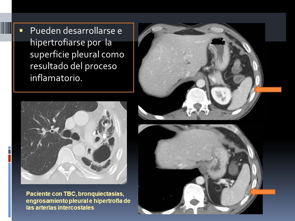 Pueden desarrollarse e hipertrofiarse por la superficie pleural como resultado del proceso inflamatorio.