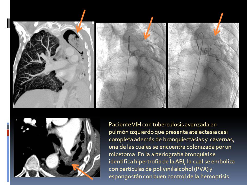 Paciente VIH con tuberculosis avanzada en pulmón izquierdo que presenta atelectasia casi completa además de bronquiectasias y cavernas, una de las cuales se encuentra colonizada por un micetoma.