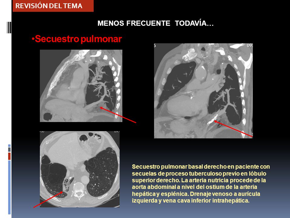 Secuestro pulmonar REVISIÓN DEL TEMA MENOS FRECUENTE TODAVÍA…