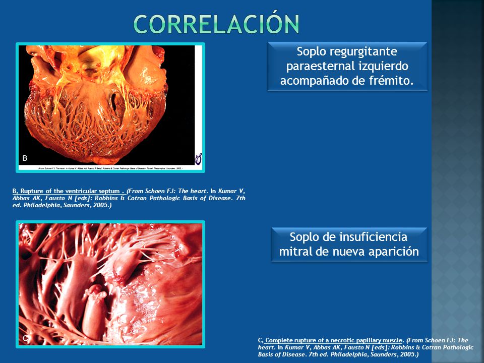 correlación Soplo regurgitante paraesternal izquierdo acompañado de frémito.