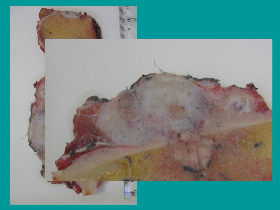 La pieza de resección correspondía a la tibia proximal, vemos que han resecado con buen margen distal el hueso y que en esta macro cortada parasagitalmente incluye las mesetas tibiales, de hecho en las radiografías de control se ve la prótesis de rodilla que le han puesto.