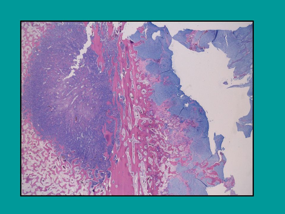 En una foto macro micro se pone de relieve una clara distinción histológica entre lo de dentro y lo de fuera, el primero una neoplasia muy celular que infiltra en su periferia entre las trabéculas del hueso esponjoso por un lado y por otro la cortical de hueso compacto de la tibia.