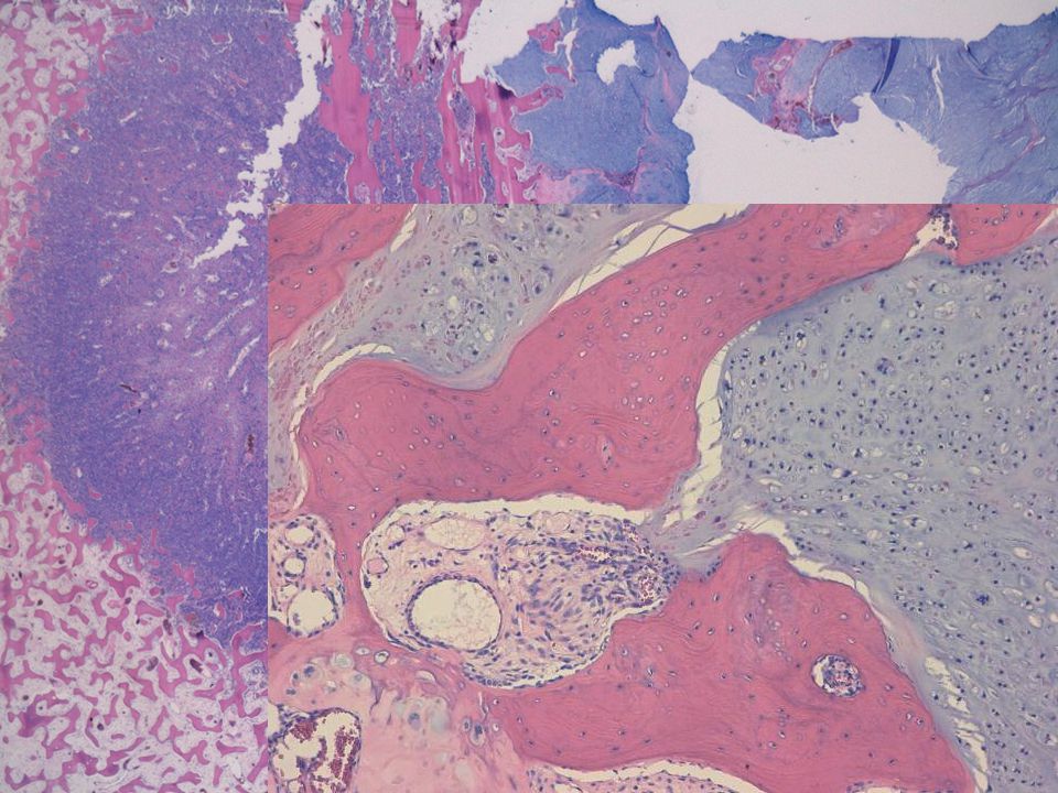 y … recuadro de ampliación y foto 2: como se veía en las pruebas de imagen: en la periferia y alejado de la cortical, contiene matriz osteoide entre los lóbulos de cartílago.