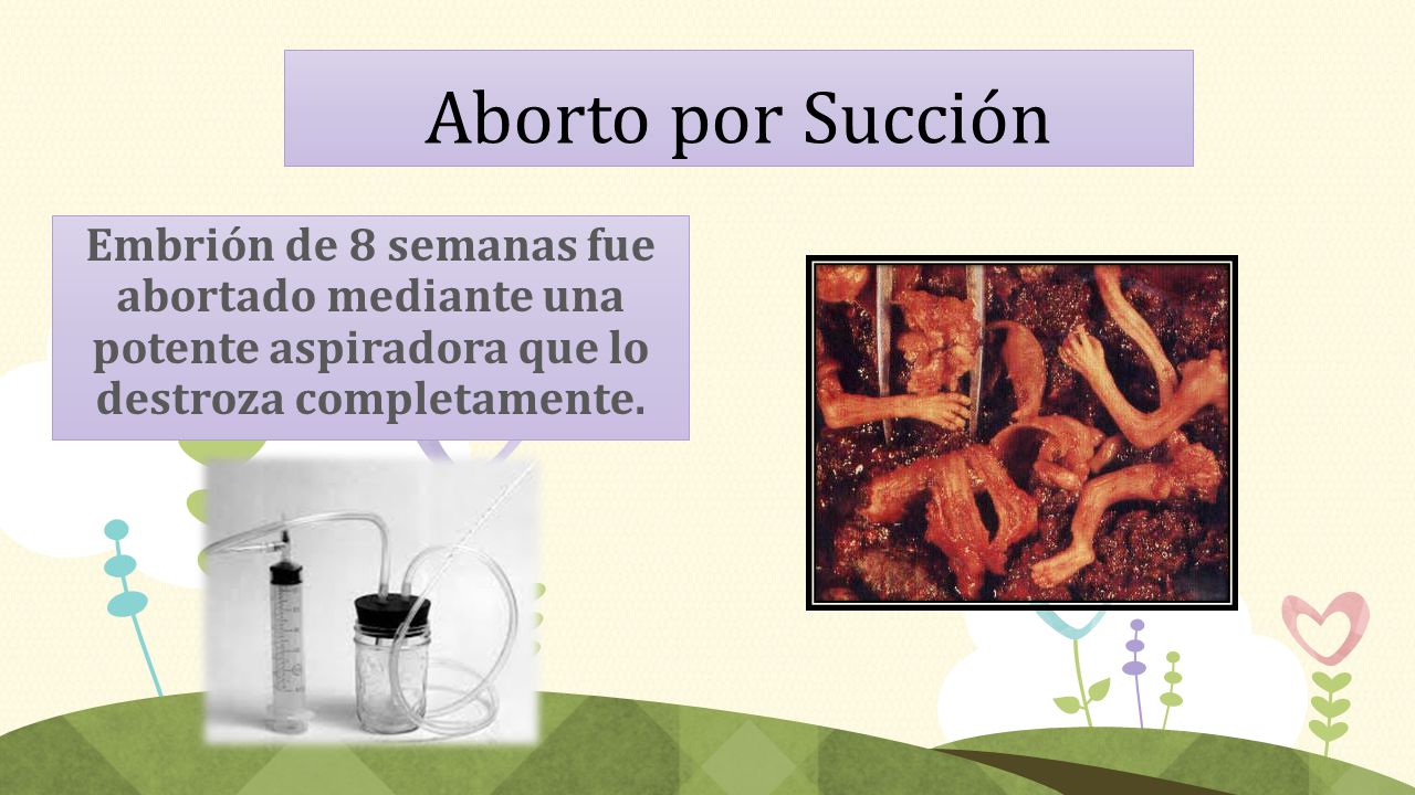 Aborto por Succión Embrión de 8 semanas fue abortado mediante una potente aspiradora que lo destroza completamente.