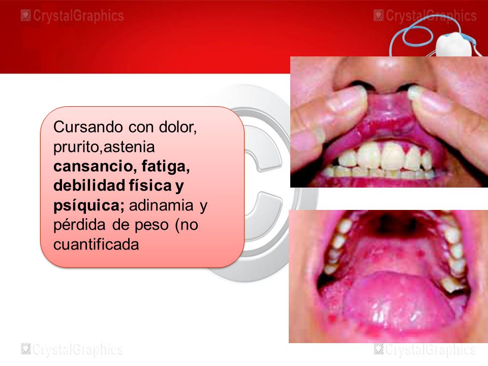 Cursando con dolor, prurito,astenia cansancio, fatiga, debilidad física y psíquica; adinamia y pérdida de peso (no cuantificada