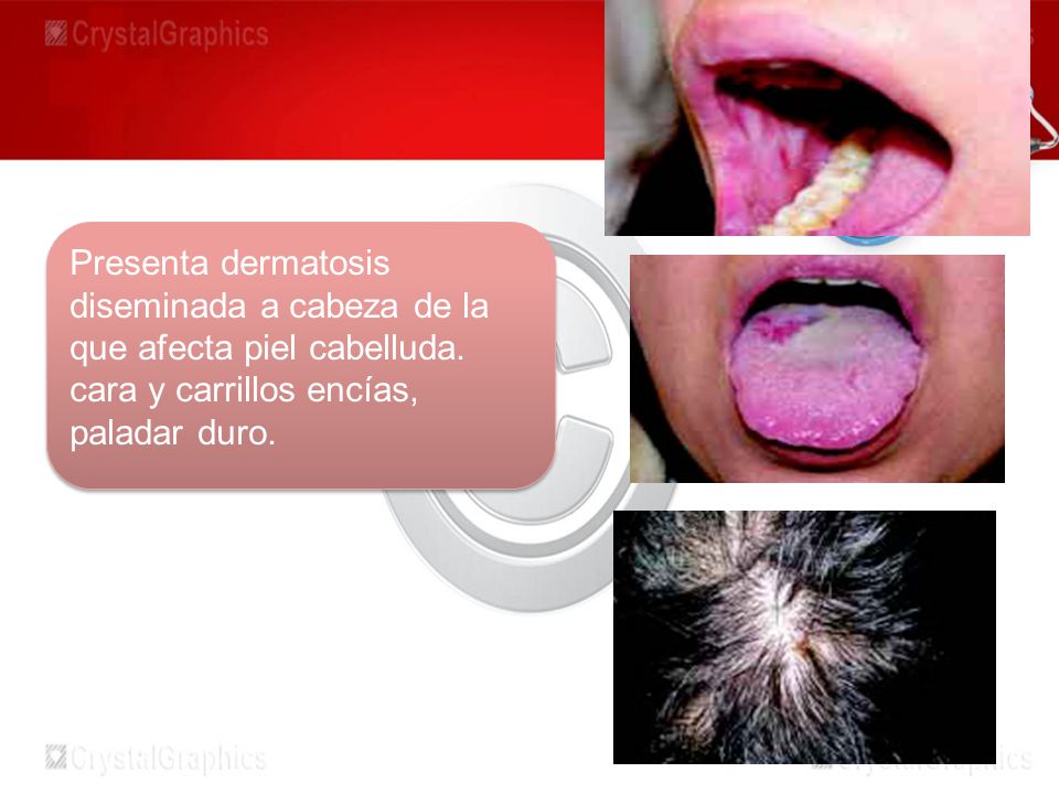 Presenta dermatosis diseminada a cabeza de la que afecta piel cabelluda.