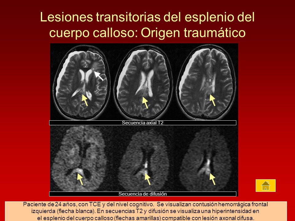 Lesiones transitorias del esplenio del cuerpo calloso: Origen traumático