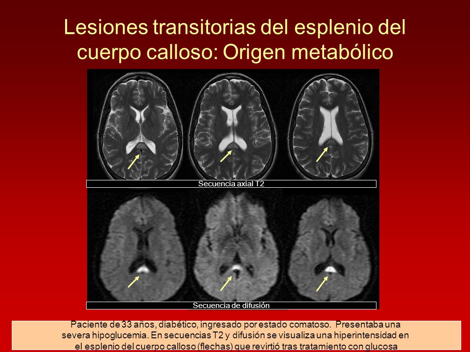 Lesiones transitorias del esplenio del cuerpo calloso: Origen metabólico