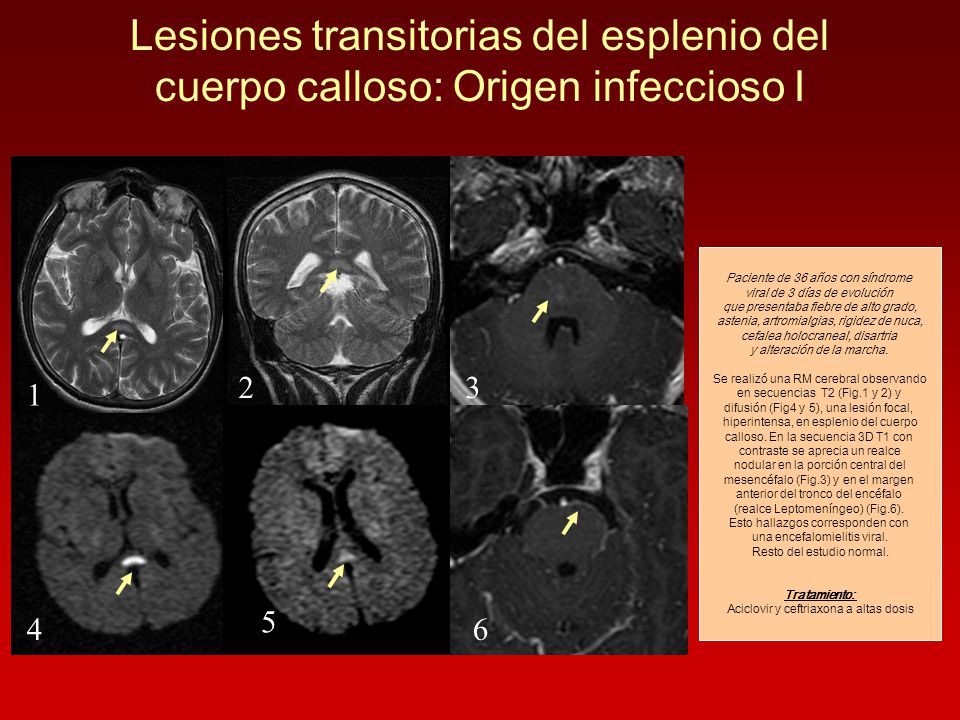 Lesiones transitorias del esplenio del cuerpo calloso: Origen infeccioso I