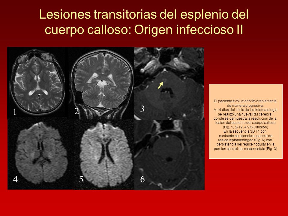 Lesiones transitorias del esplenio del cuerpo calloso: Origen infeccioso II