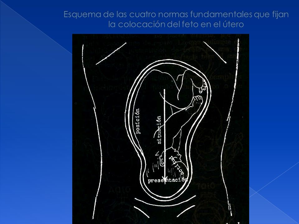 Esquema de las cuatro normas fundamentales que fijan la colocación del feto en el útero