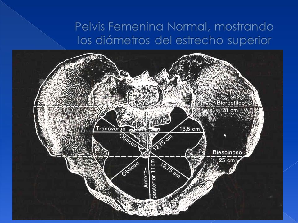 Pelvis Femenina Normal, mostrando los diámetros del estrecho superior