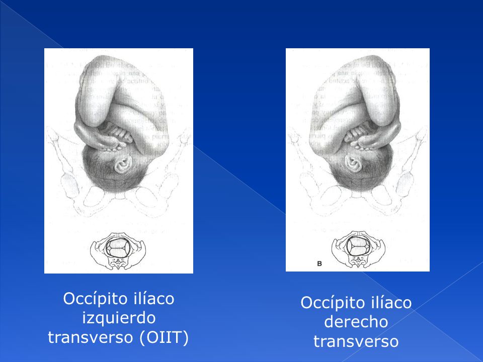 Occípito ilíaco izquierdo transverso (OIIT)