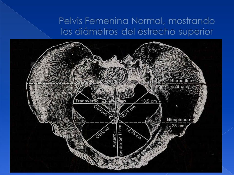Pelvis Femenina Normal, mostrando los diámetros del estrecho superior