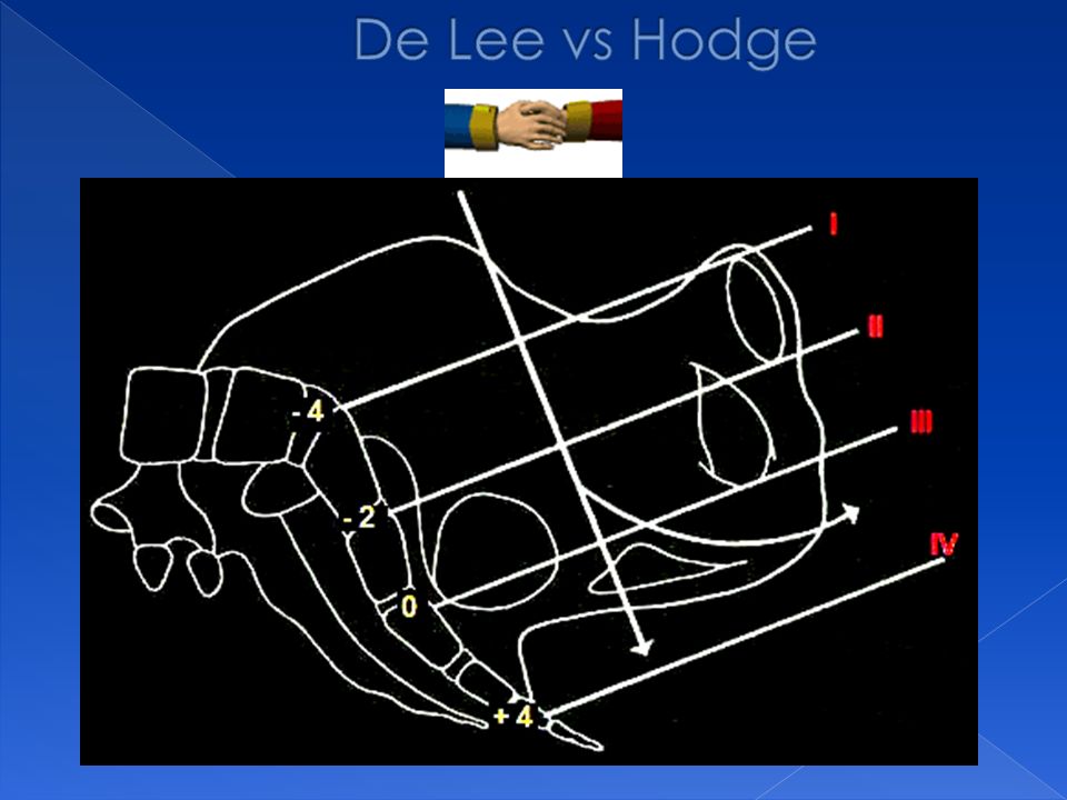 De Lee vs Hodge