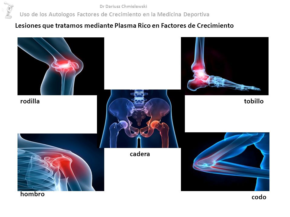 Lesiones que tratamos mediante Plasma Rico en Factores de Crecimiento