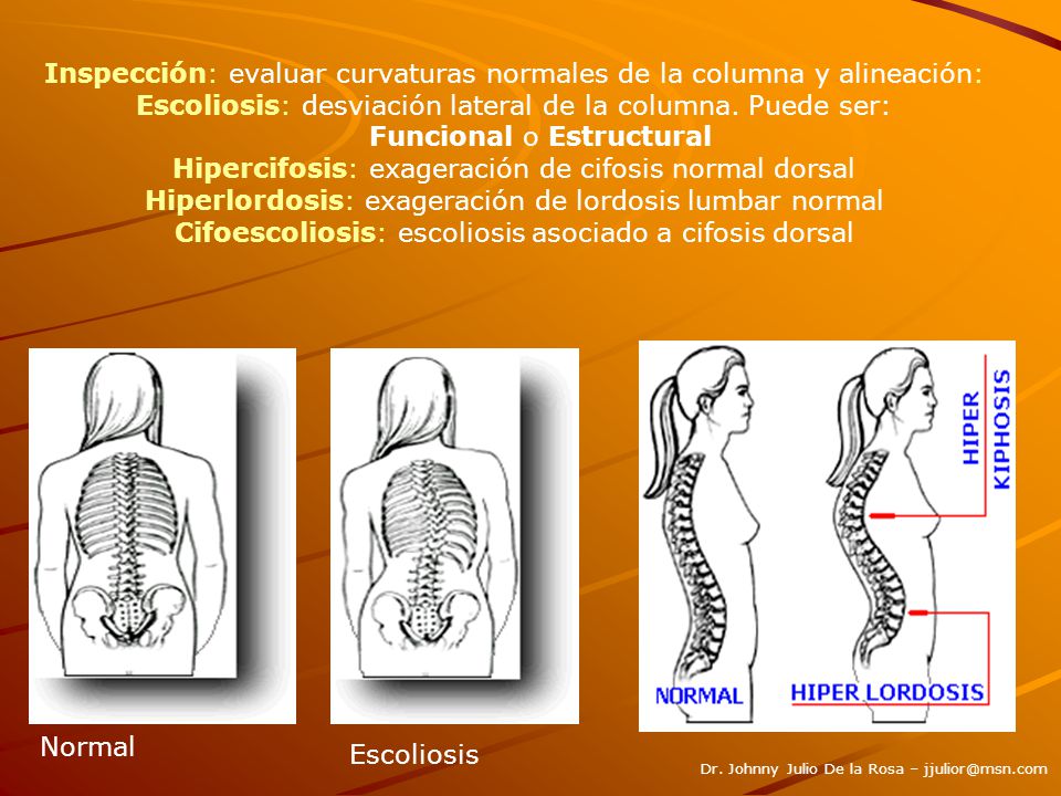 Inspección: evaluar curvaturas normales de la columna y alineación: