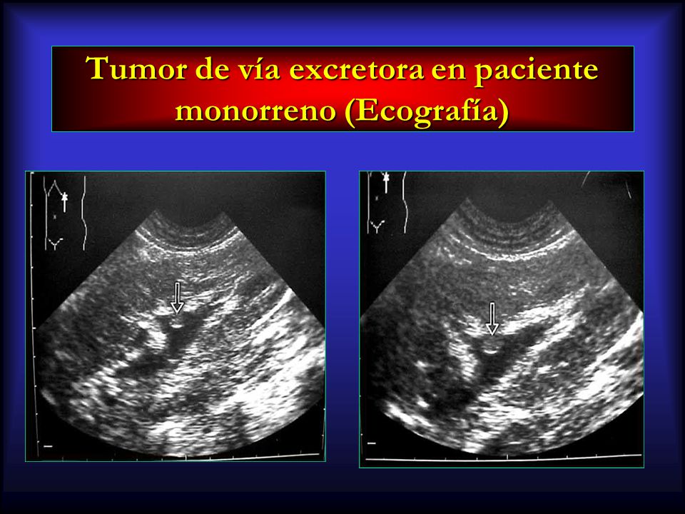 Tumor de vía excretora en paciente monorreno (Ecografía)