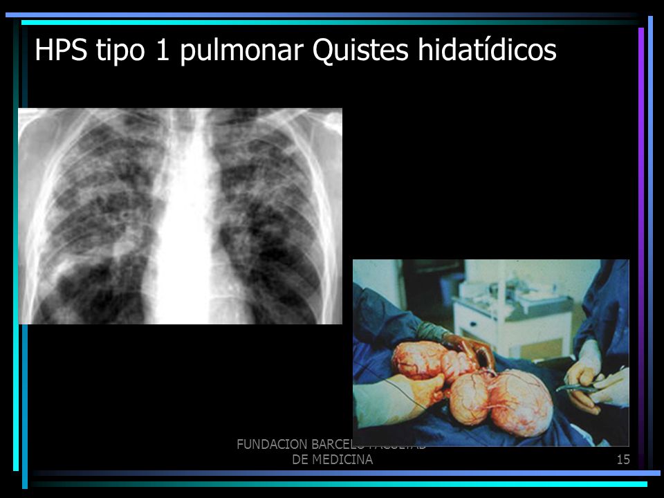HPS tipo 1 pulmonar Quistes hidatídicos