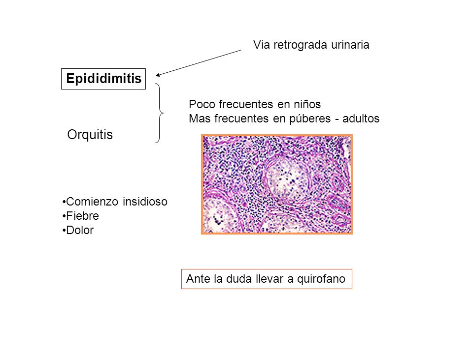 Epididimitis Orquitis Via retrograda urinaria Poco frecuentes en niños
