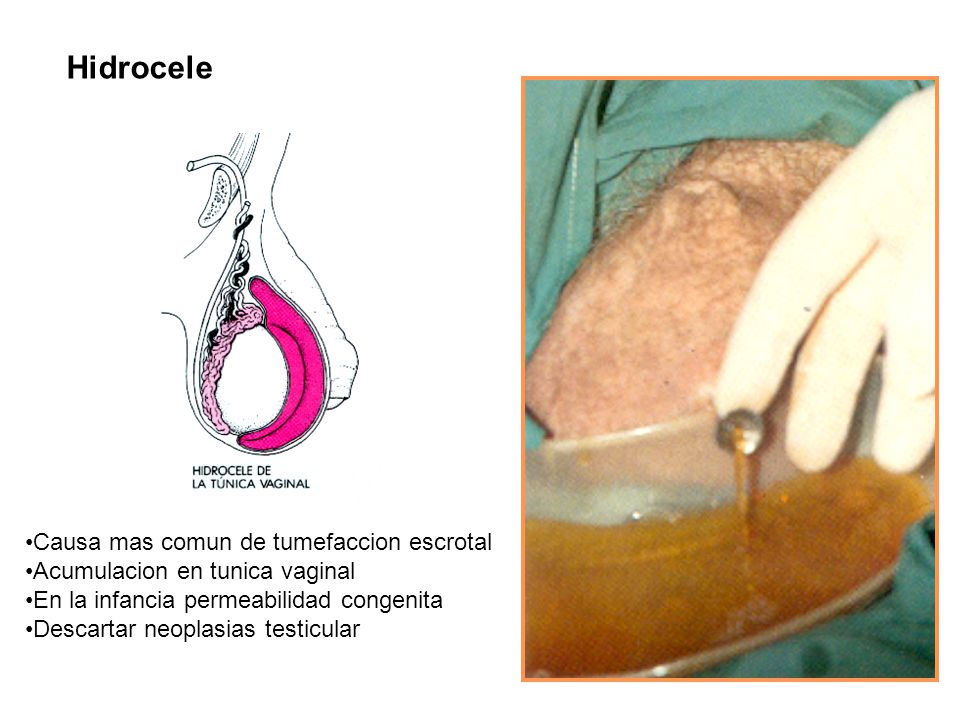 Hidrocele Causa mas comun de tumefaccion escrotal
