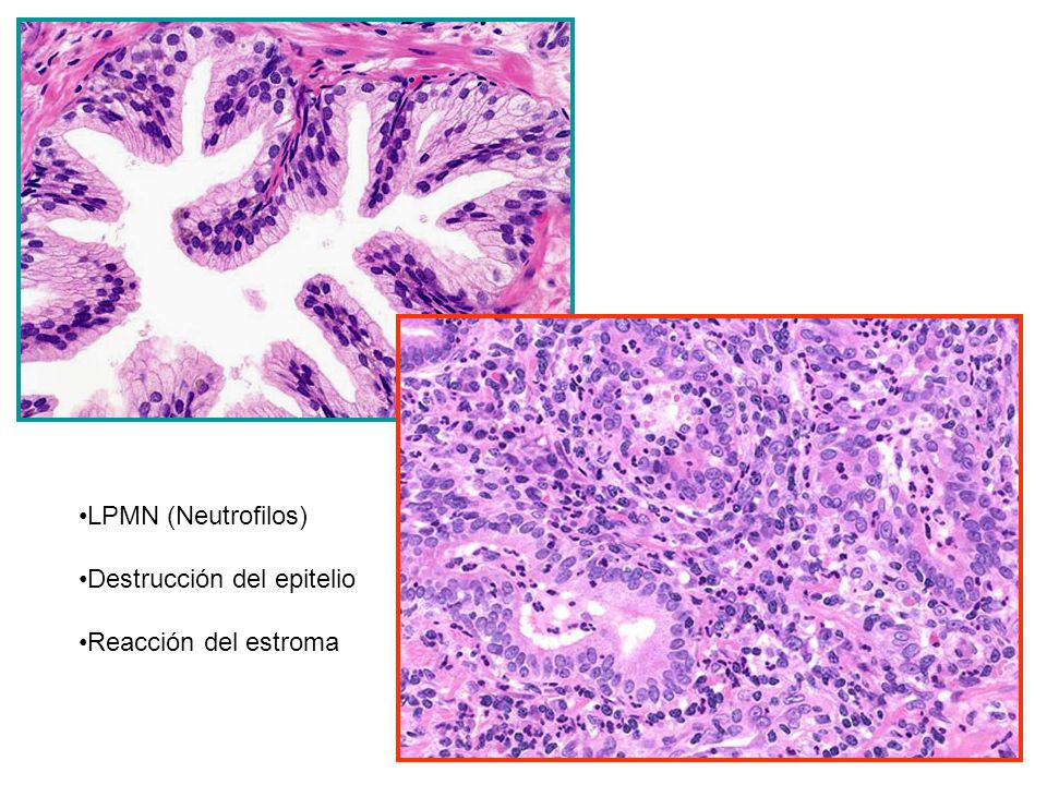 LPMN (Neutrofilos) Destrucción del epitelio Reacción del estroma